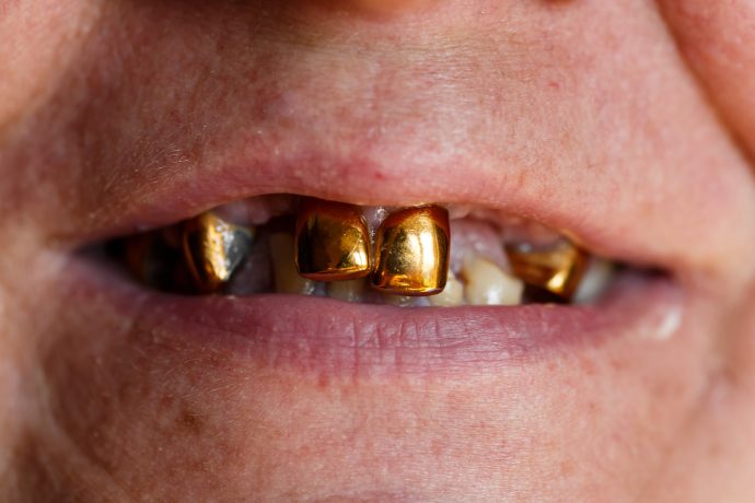 Nahaufnahme des Mundes einer Person, in der auf mehreren oberen Vorderzähnen goldene Zahnkronen zu sehen sind, die wie Bitcoin in den Schlagzeilen der Financial Times funkeln.